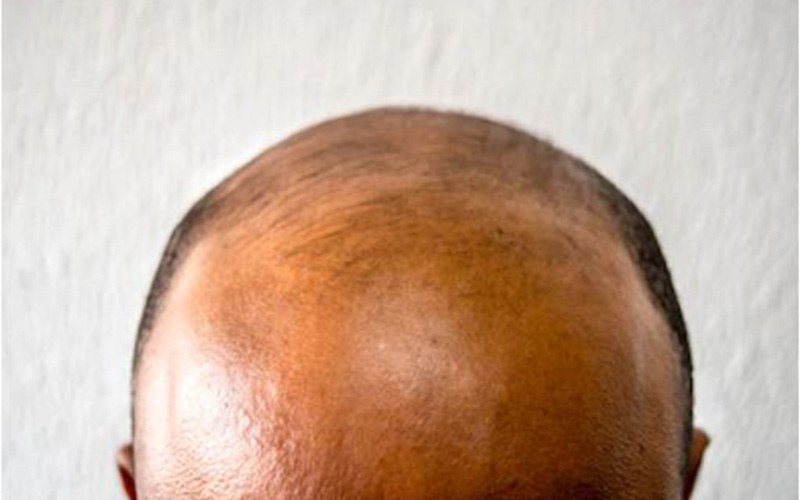 Baldness cure possible as scientists re-grow hair on mice - The Standard  Entertainment