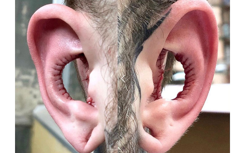 Would you try it? New trend where people remove part of their ear