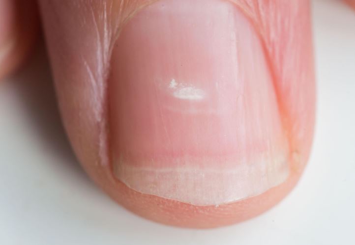 Health problems your fingernails can indicate - from white spots to ridges  - The Standard Entertainment
